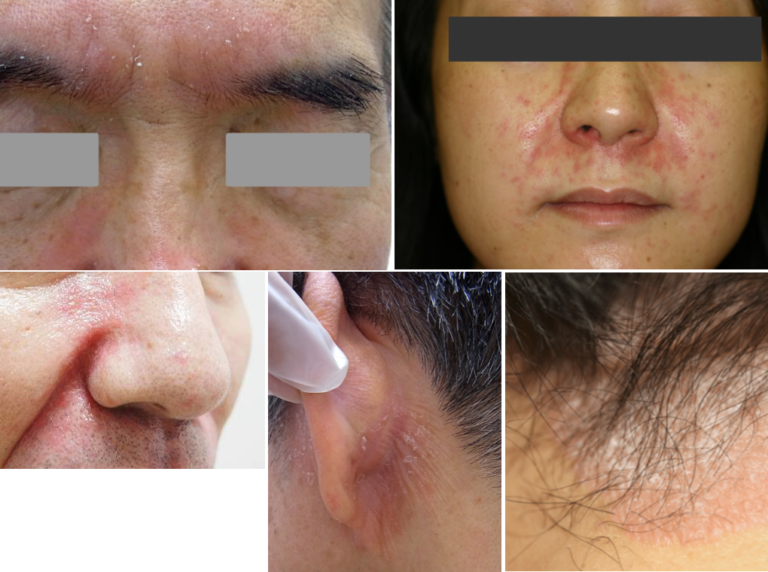 脂漏性皮膚炎と乾癬の原因