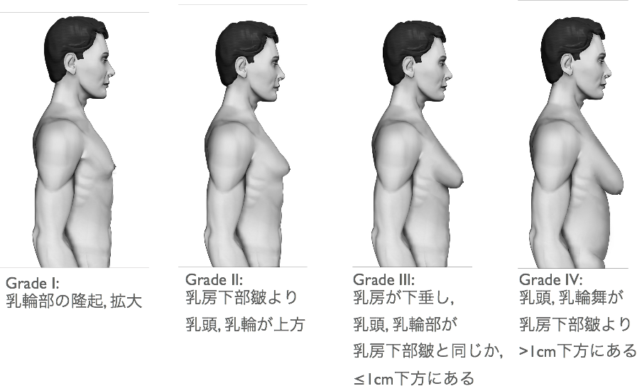 男性の女性化乳房 天王寺こいでクリニック 心療内科 神経内科 栄養療法