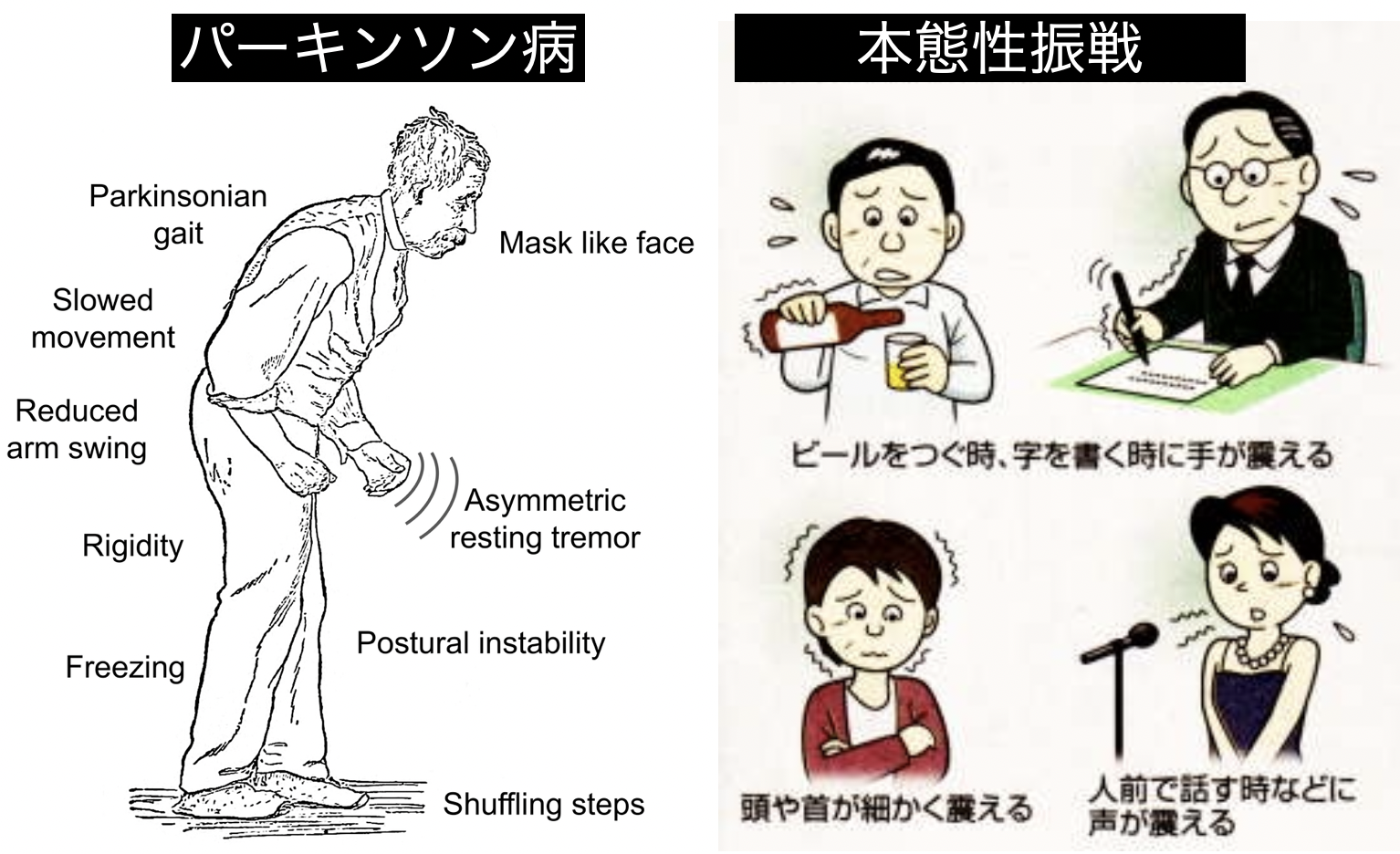 パーキンソン病と本態性振戦 - 天王寺こいでクリニック 心療内科・神経内科・栄養療法