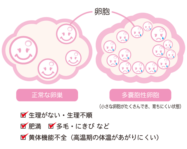 PCOSが生殖能力に与える影響