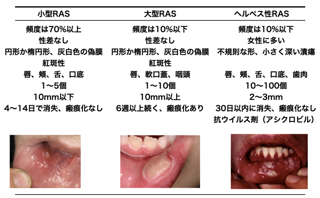 口内炎が治っているときはどのように見えるのでしょうか?