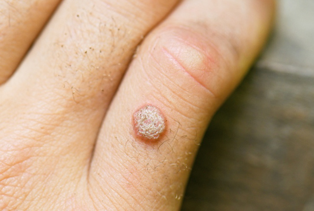 疣贅（いぼ）のみかた、治療のしかた いぼ｜大田区大森・大木皮膚科【尋常性疣贅・イボ治療専門外来】