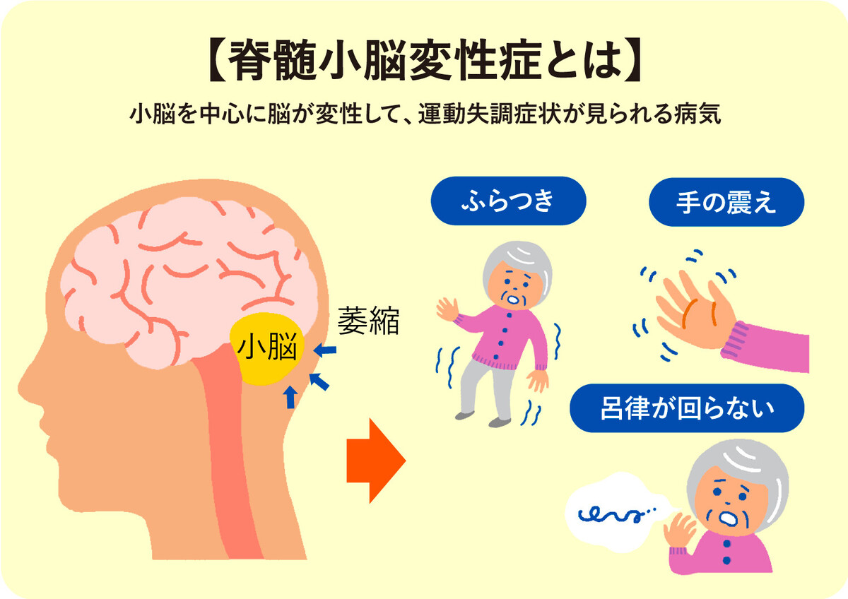 脊髄小脳変性症の漢方治療 - 天王寺こいでクリニック 心療内科